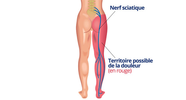 Illustration présentant le nerf sciatique | Dr François Auger Chiropraticien - Chiropratique Québec, Chiro Nord, Stoneham, NDL, Lac Saint-Charles
